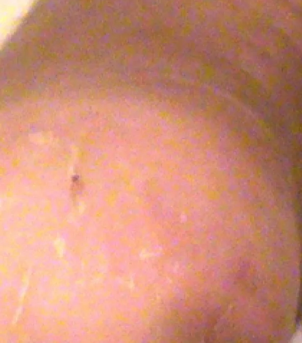 The same skin after 7 days of using the cream