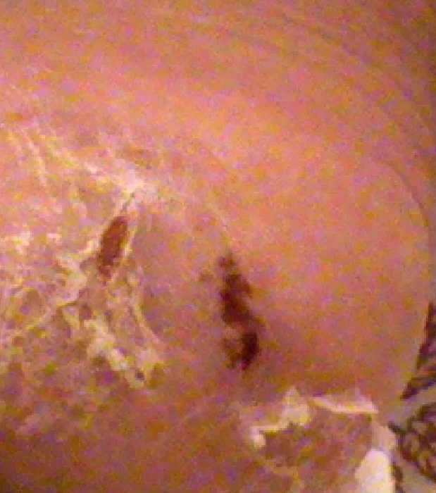Dry, cracked skin before using the cream