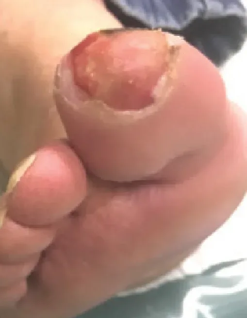 Diabetic foot ulcer, initial