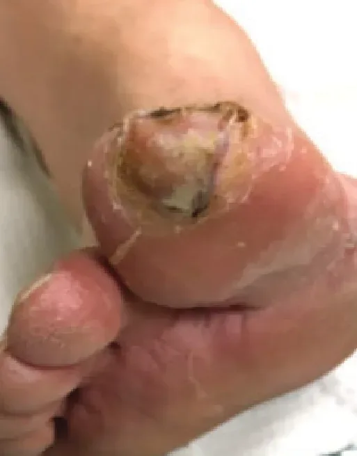 Diabetic foot ulcer, week 2