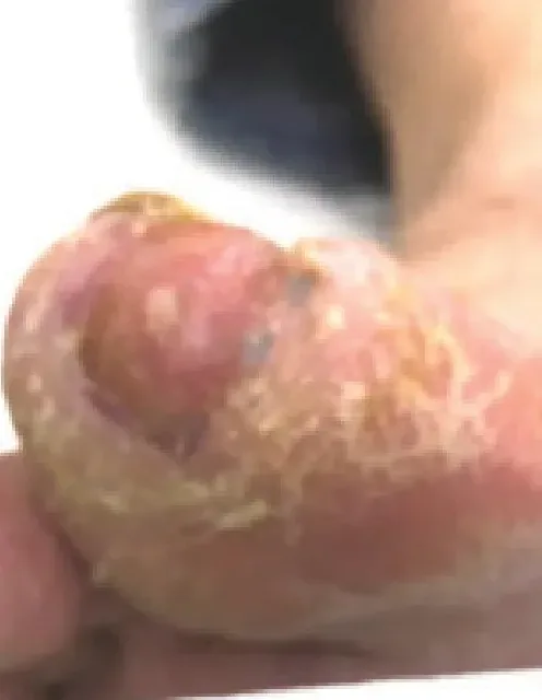 Diabetic foot ulcer, week 4