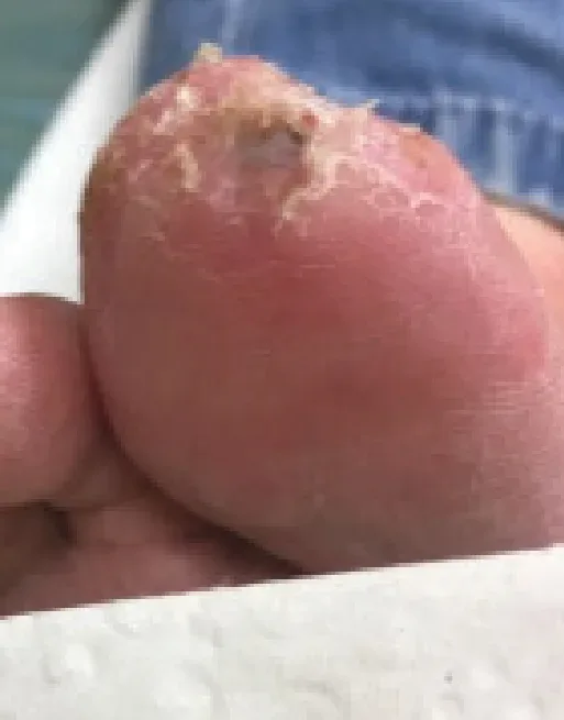 Diabetic foot ulcer, week 6