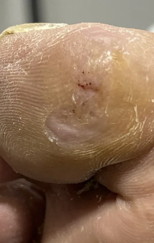Diabetic ulcer of the hallux, day 12