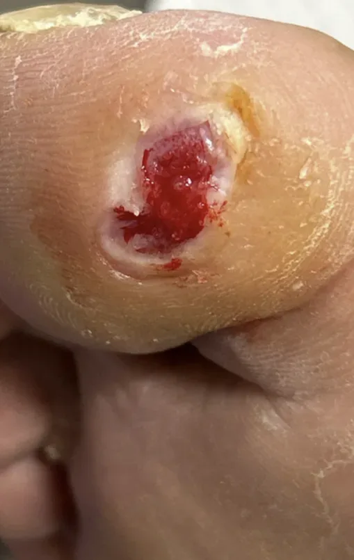 Diabetic ulcer of the hallux, initial