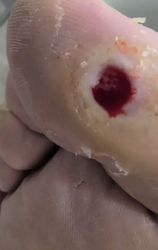 Chronic hallux ulcer, initial