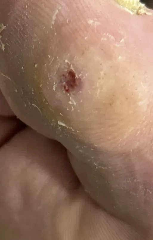 Chronic hallux ulcer, week 2
