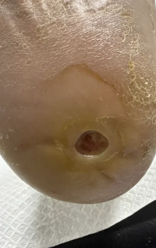 Plantar heel ulcer, initial