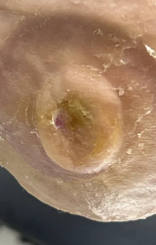 Plantar heel ulcer, month 2