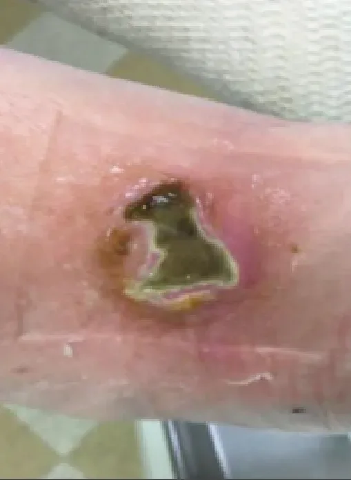 Diabetic foot laceration, initial