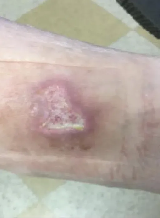 Diabetic foot laceration, week 2