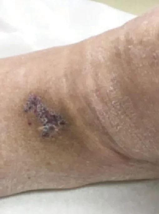 Diabetic foot laceration, week 5