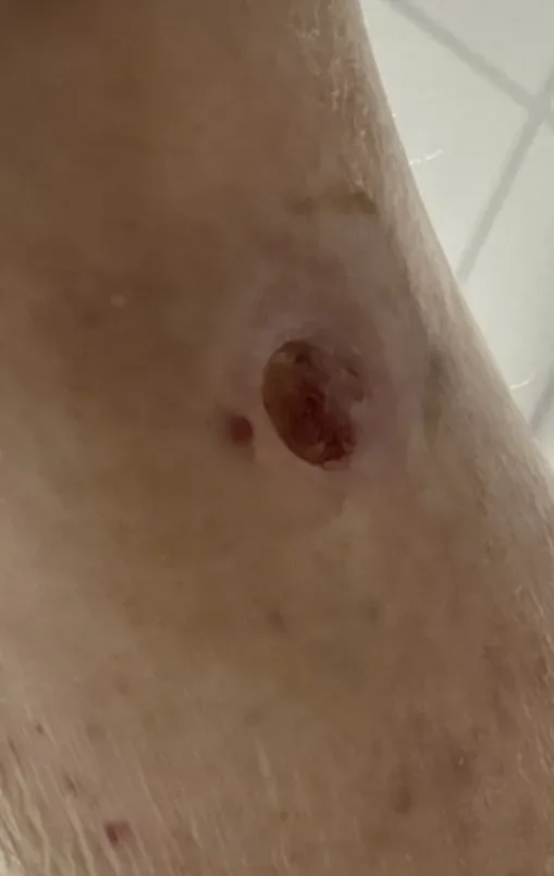 Lower leg ulcer with edema, initial