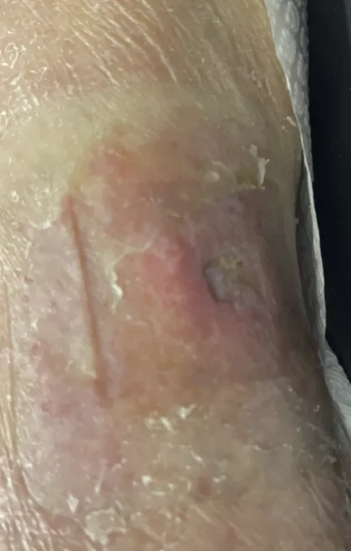 Lower leg ulcer with edema, month 2