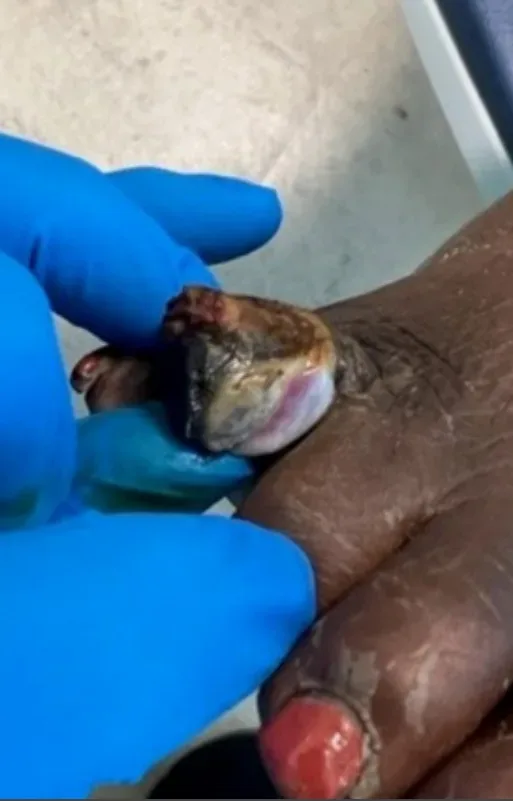 Necrotic eschar of the fourth toe, month 2