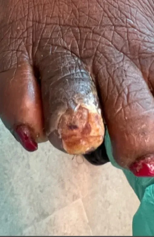 Necrotic eschar of the fourth toe, month 3