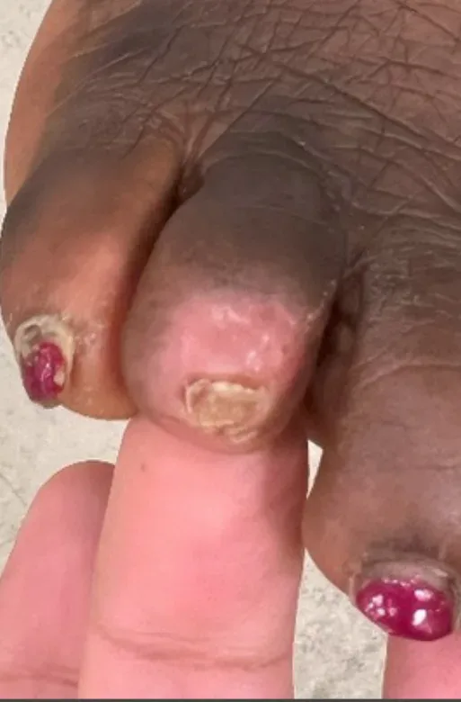Necrotic eschar of the fourth toe, later