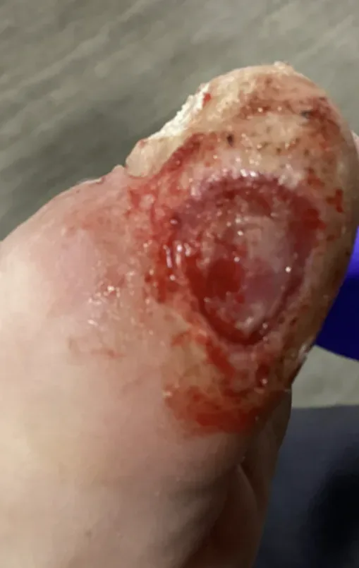 Hallux ulcer with verruca, initial