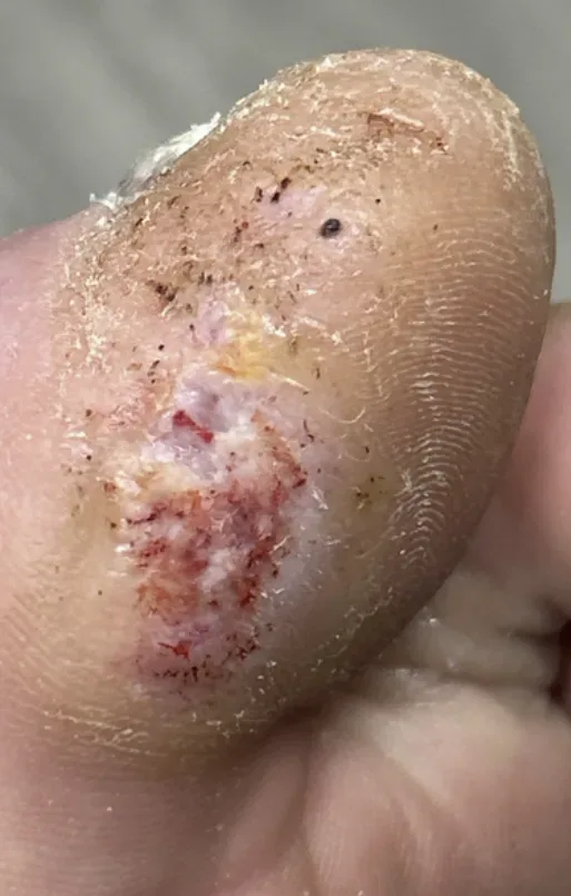 Hallux ulcer with verruca, month 3