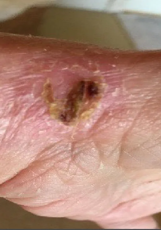 Partial-thickness burn, day 4
