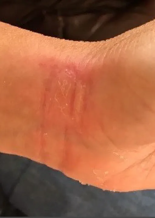 Partial-thickness burn, day 7