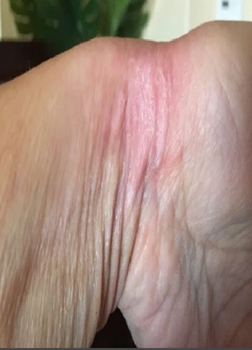 Partial-thickness burn, day 9