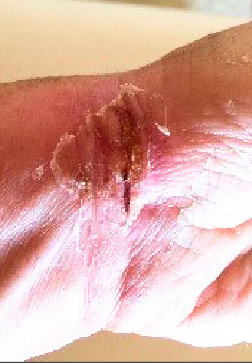 Partial-thickness burn, initial