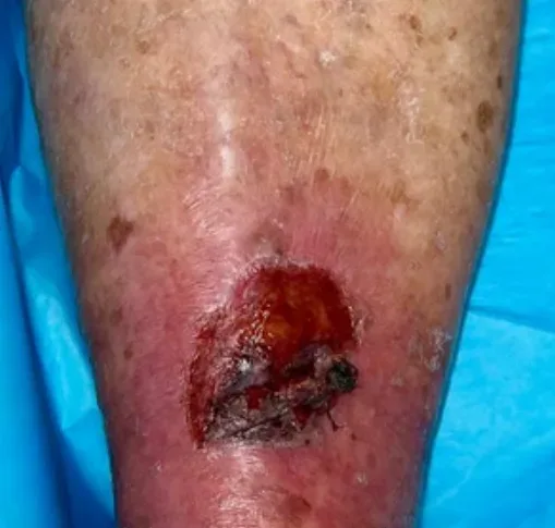 Traumatic lower leg wound, initial