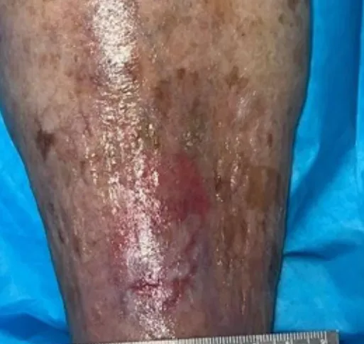 Traumatic lower leg wound, week 3