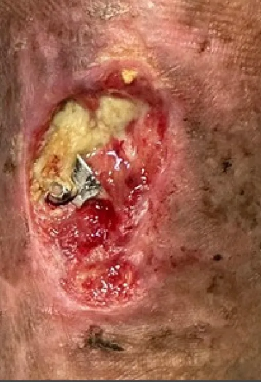 Chronic traumatic lower leg wound, initial