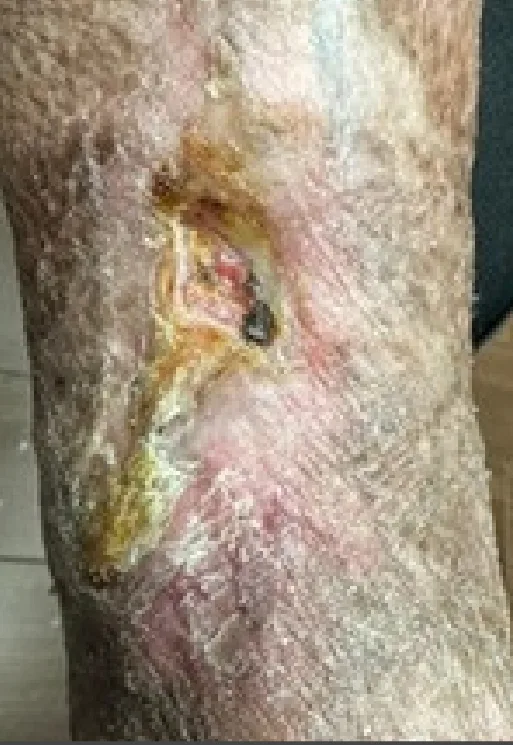 Chronic traumatic lower leg wound, month 1