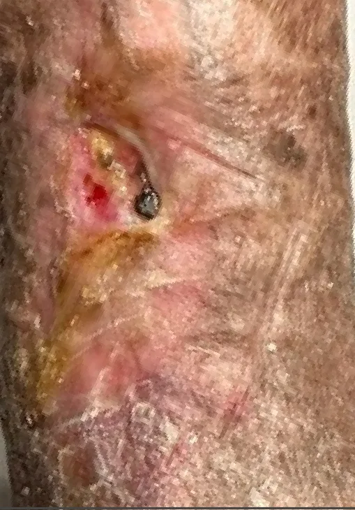 Chronic traumatic lower leg wound, month 2