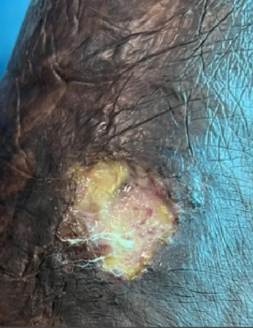 Medial malleolus venous ulcer, initial