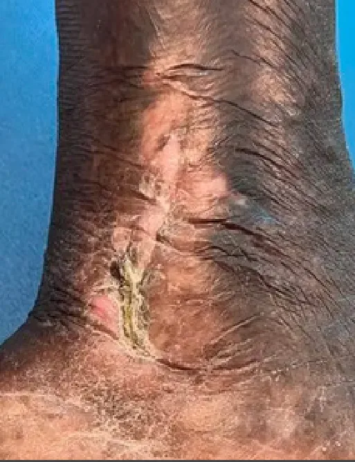 Medial malleolus venous ulcer, week 16