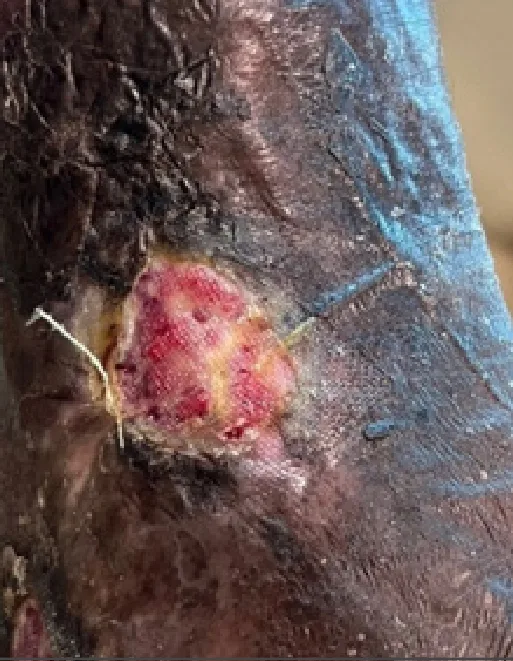 Medial malleolus venous ulcer, week 6