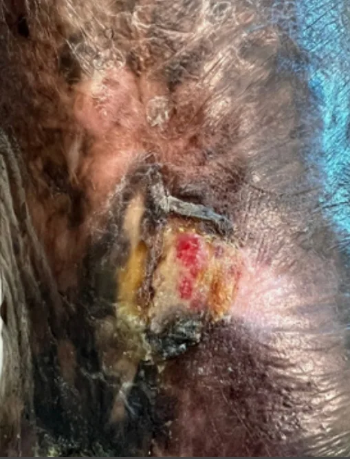 Medial malleolus venous ulcer, week 8