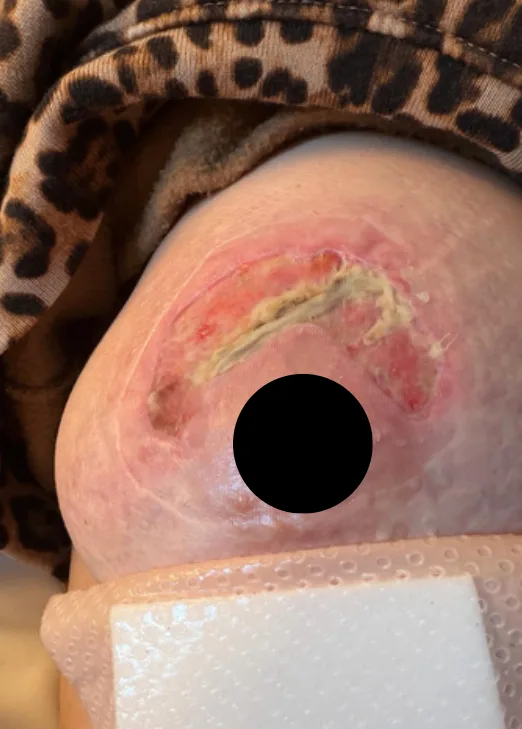 Post-breast augmentation incision, initial
