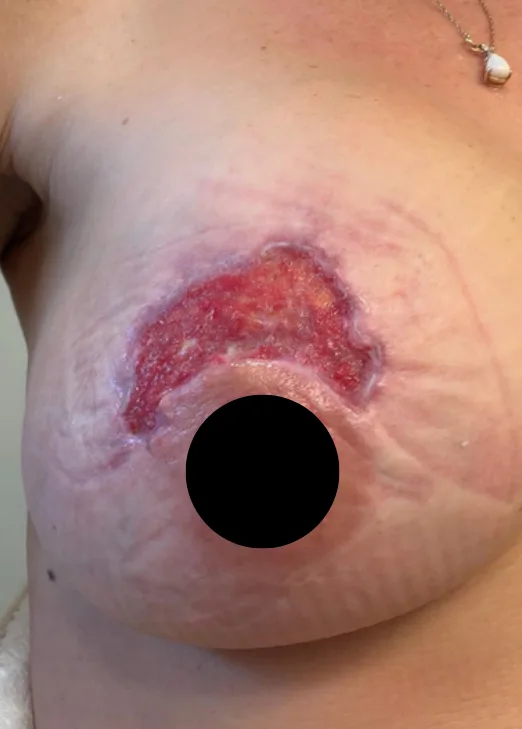 Post-breast augmentation incision, week 1