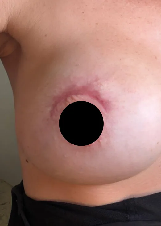 Post-breast augmentation incision, week 3