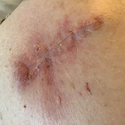 Post-op dermatologic incision, week 1