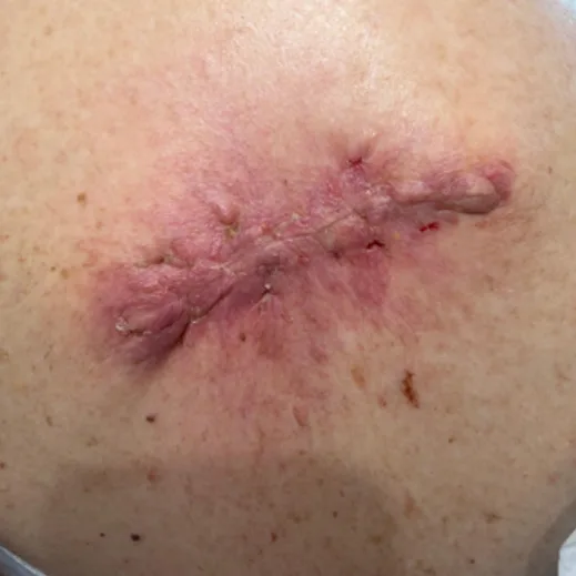 Post-op dermatologic incision, before