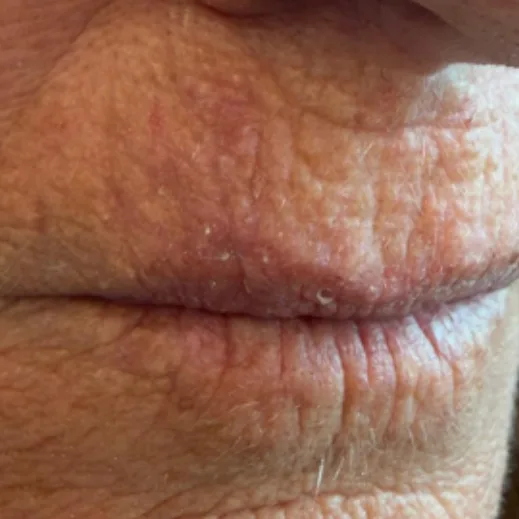 Post-op dermatologic incision, day 5
