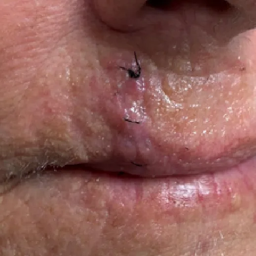 Post-op dermatologic incision, before