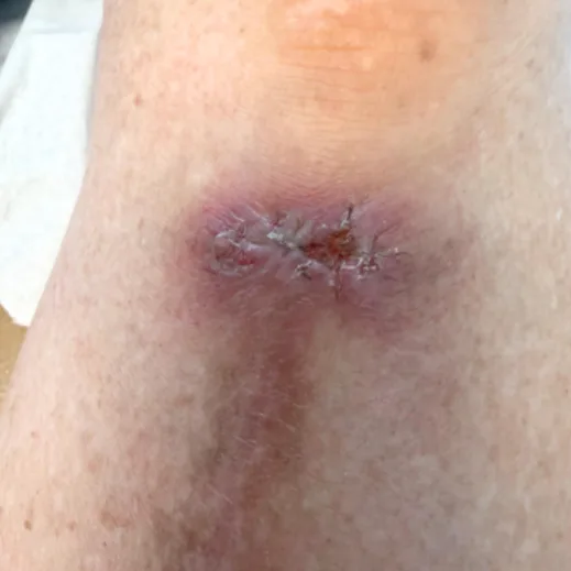 Post-op dermatologic incision, week 2