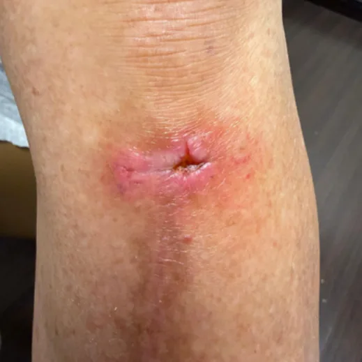 Post-op dermatologic incision, before