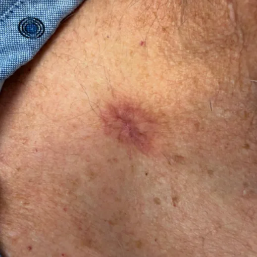 Post-op dermatologic incision, day 10