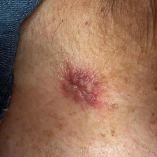 Post-op dermatologic incision, before